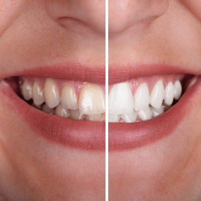 Photo showing before and after teeth whitening treatment